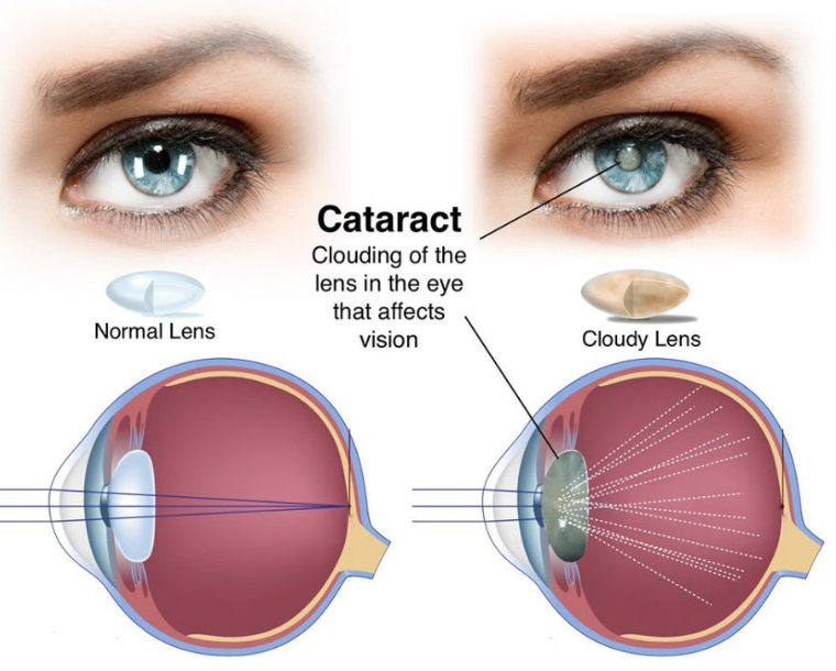 백내장의 정의