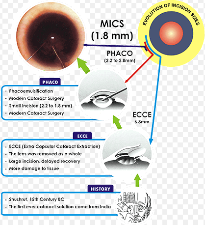 백내장 수술의 발전