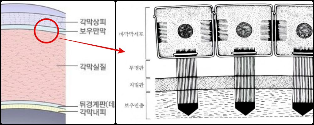 재발성 각막 미란 부착복합체