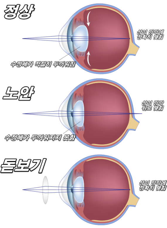 presbyopia