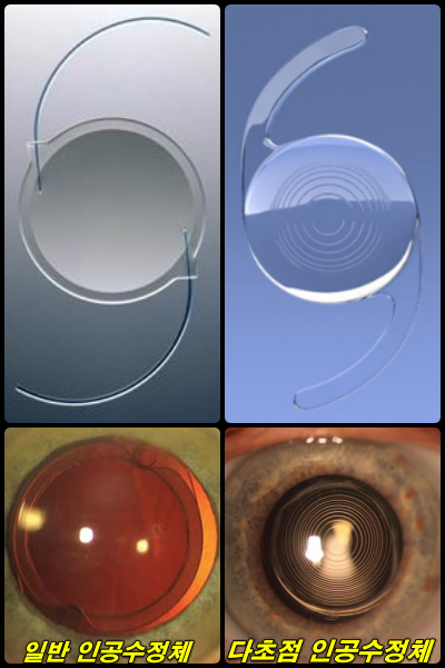 multifocal intraocular lens