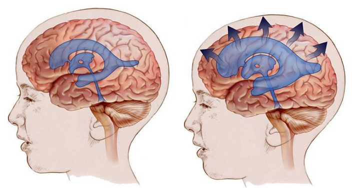 두통- 뇌압상승