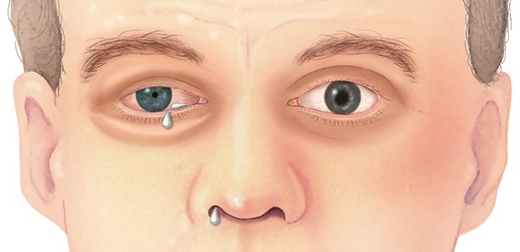 군발두통-눈주변 통증