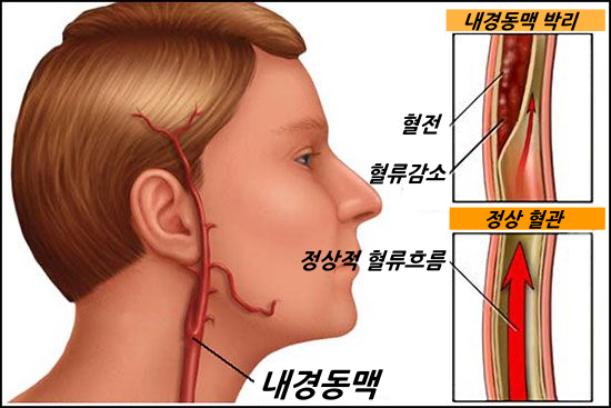 내경동맥 박리- 두통