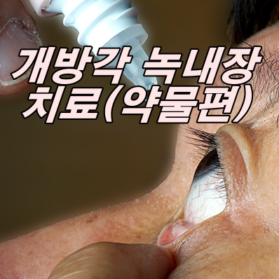 녹내장 치료(개방각녹내장의 약물 치료)(Part. 4)