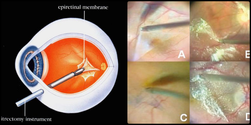Removal of the epiretinal membrane through vitrectomy