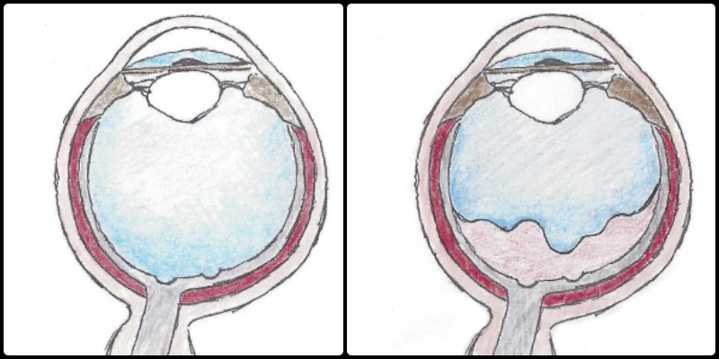 posterior vitreous detachment
