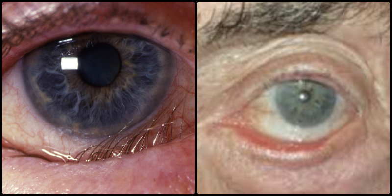 Valvavar and valgus- Causes of dry eye syndrome