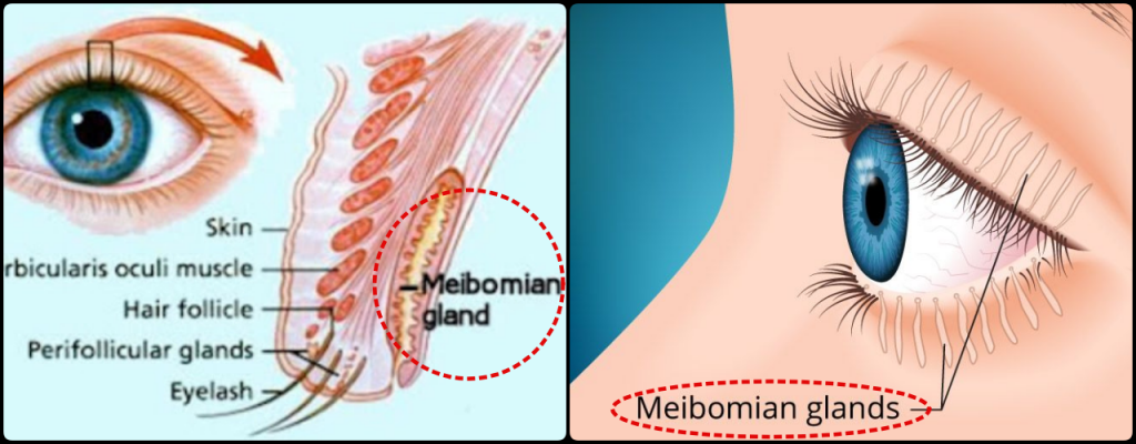 Meibomian gland - causes of dry eye syndrome