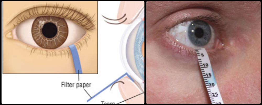 Dry Eye Test - Shimmer Test