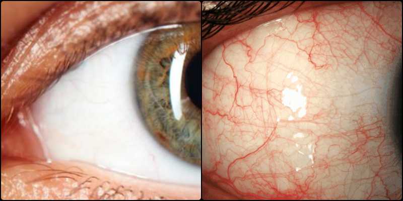 눈 충혈 안약 - 정상과 충혈안