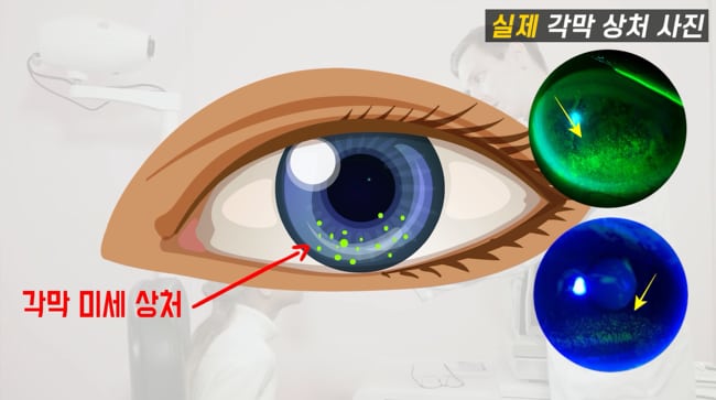 눈 피로감 - 안구건조증