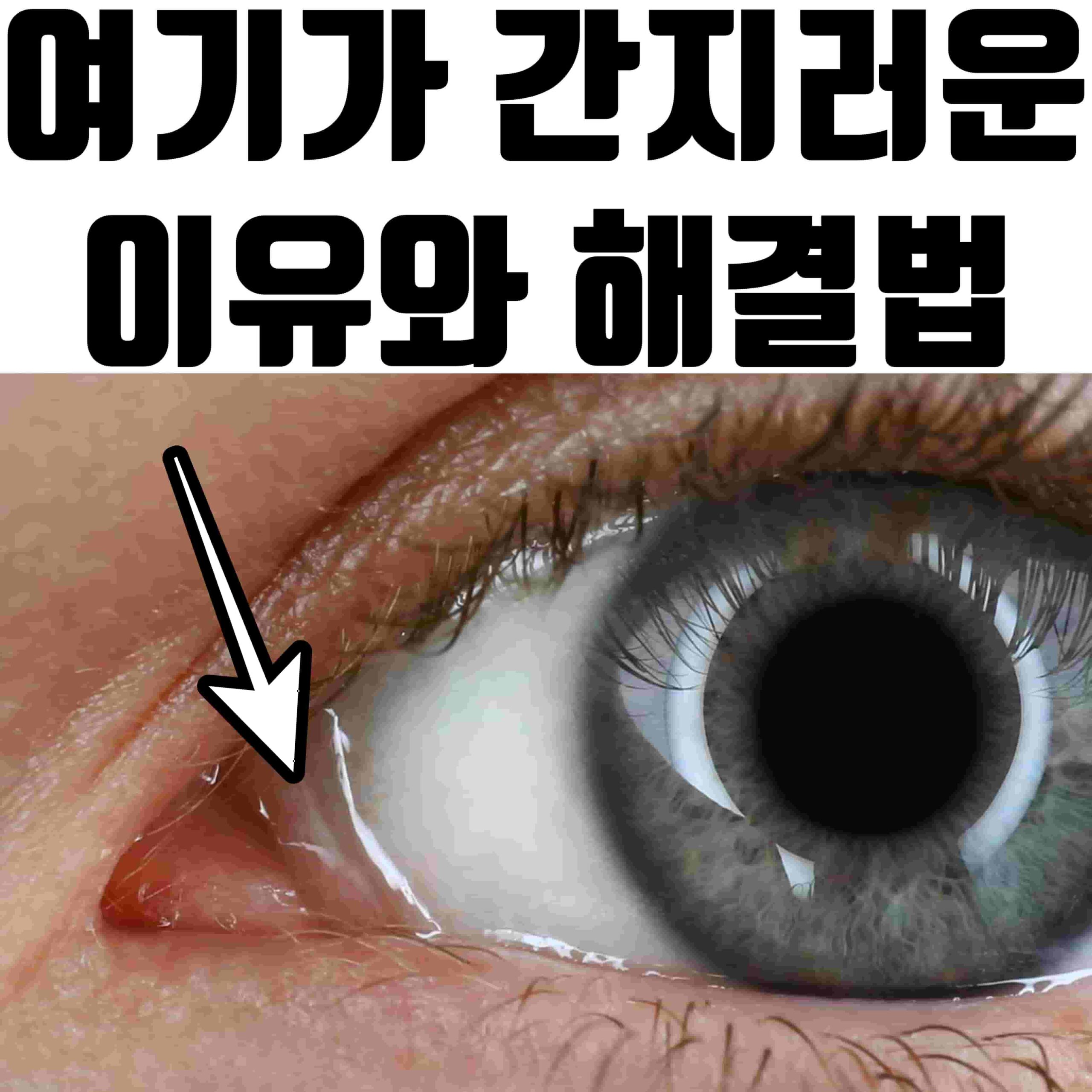 눈 안쪽 가려움, 눈 안쪽 부음 - 도대체 이 부위는 뭘까요?