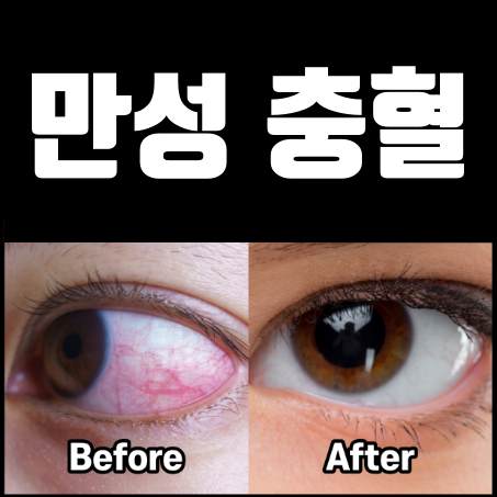 한쪽 눈 충혈, 눈 충혈 안약은 함부로 사용하지 마세요!