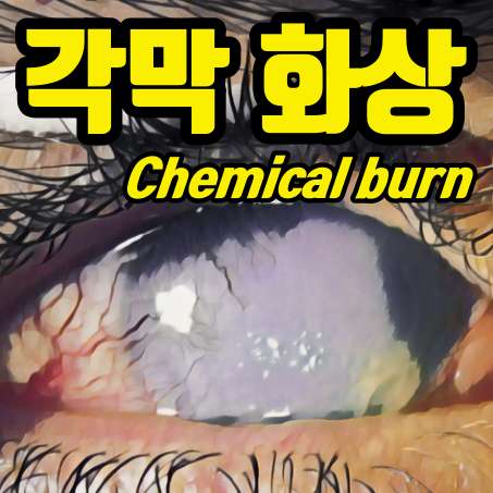 각막 화상, 안구 화학 화상(Chemical Burn) - 안과 응급실 노트