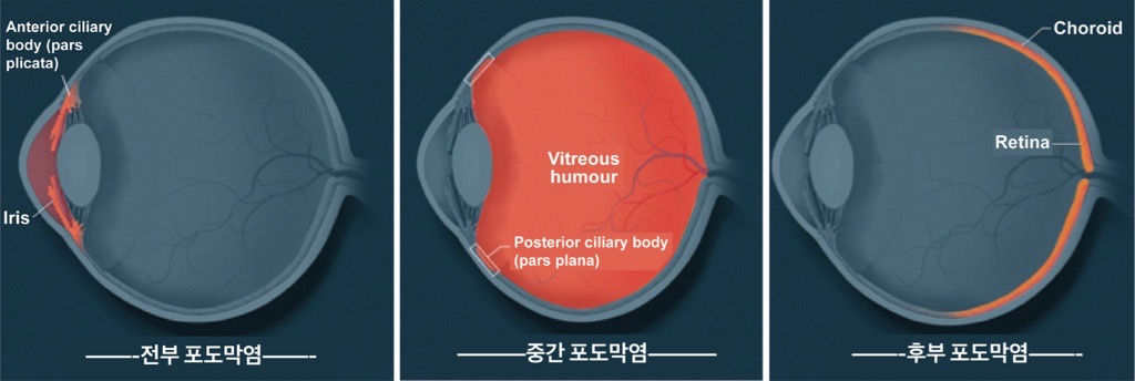 Location of uveitis