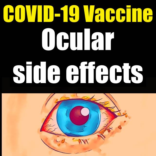 Pfizer eyelid edema, Pfizer eyelid twitching (feat. COVID-19 vaccine ocular side effects) - Part 1