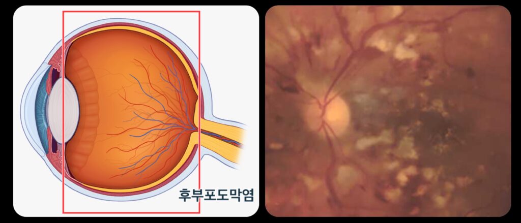 Pfizer retinitis, posterior uveitis