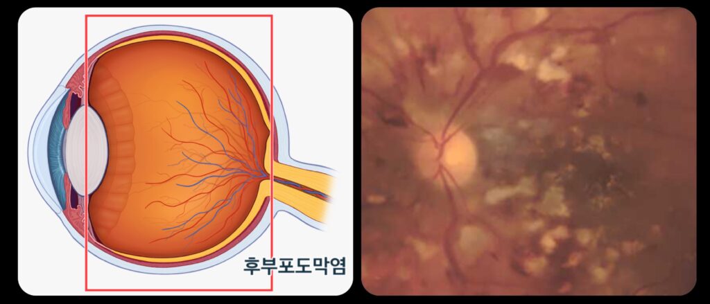 화이자 망막염, 후부 포도막염