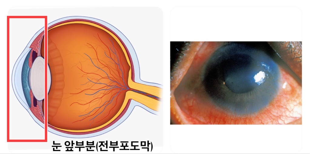 화이자 눈통증, 화이자 눈충혈(코로나 백신 안과 부작용에 대한 고찰)-Part. 2