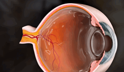 Probability of retinal tear leading to retinal detachment (feat. retinal tear laser treatment)