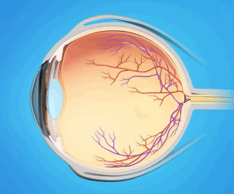 Probability of retinal tear leading to retinal detachment (feat. retinal tear laser treatment)