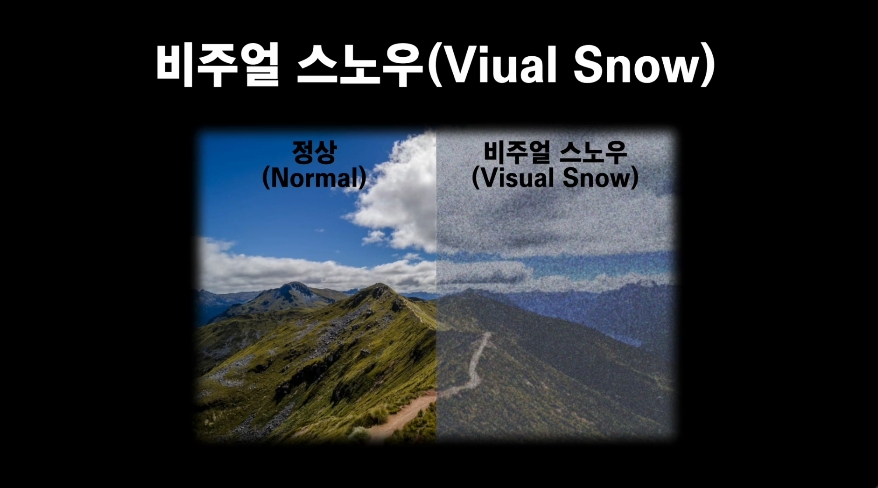 비주얼 스노우 증상
Symptoms of Visual Snow