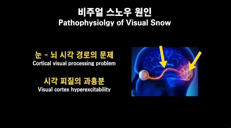 비주얼 스노우 원인
Pathophysiology of visual snow
