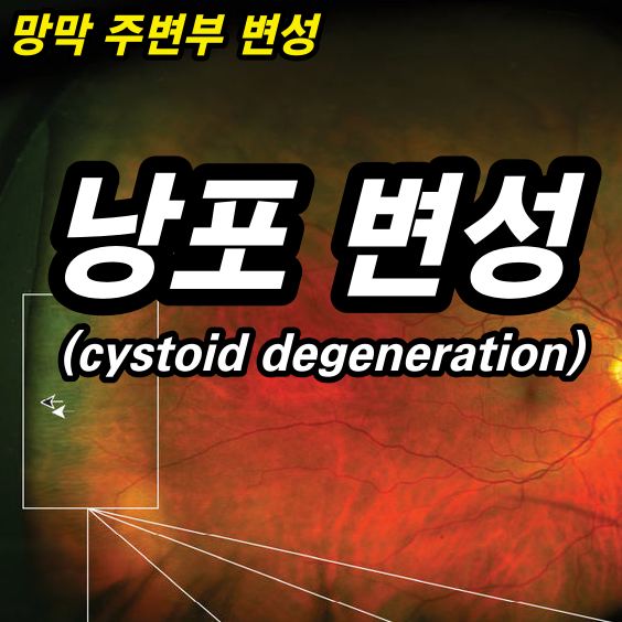 낭포 변성(cystoid degeneration) - 망막 주변부 변성 4