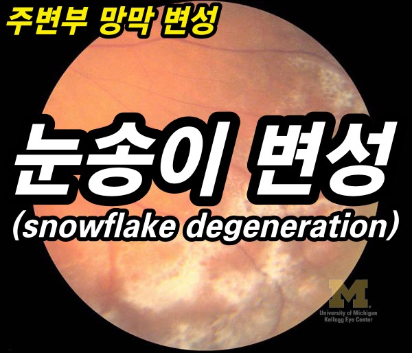 눈송이 변성(snowflake degeneration) - 망막 주변부 변성 5