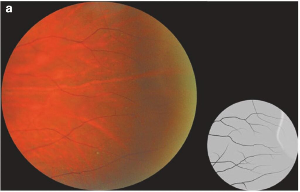 퇴행성 망막층간분리(senile retinoschisis) - 망막 주변부 변성 1