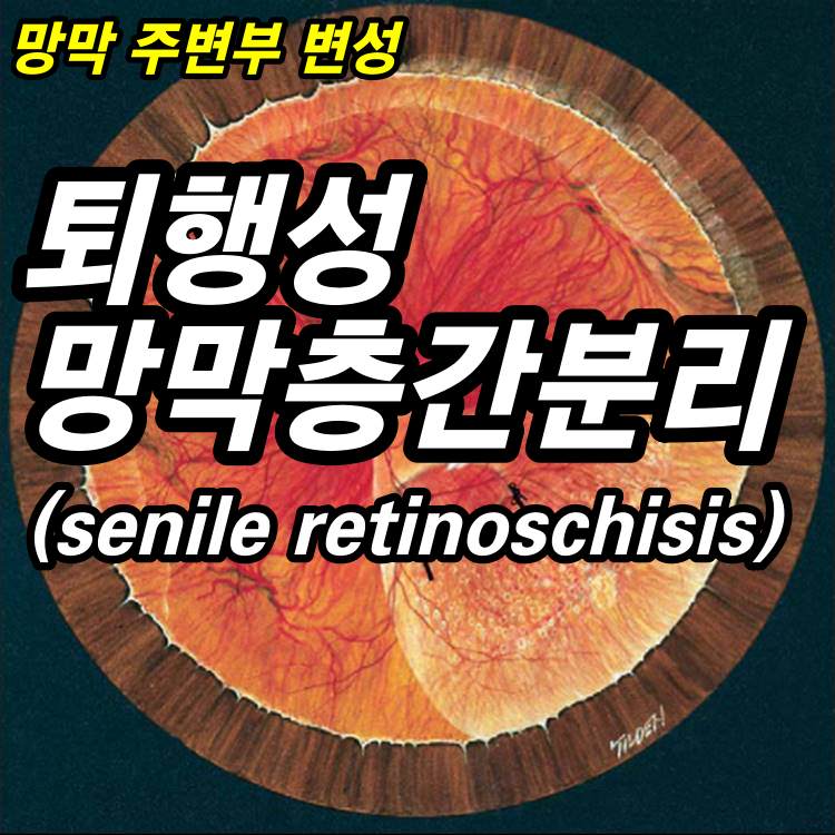 퇴행성 망막층간분리(senile retinoschisis) - 망막 주변부 변성 1
