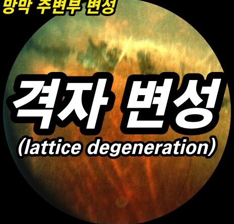 망막 격자변성(lattice degeneration) - 망막 주변부 변성 7