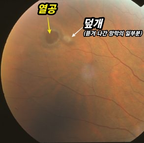 망막 열공(retinal tear) - 망막 주변부 변성 9