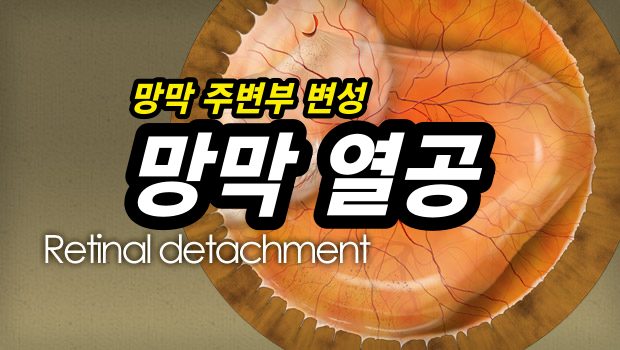 망막 열공(retinal tear) - 망막 주변부 변성 9