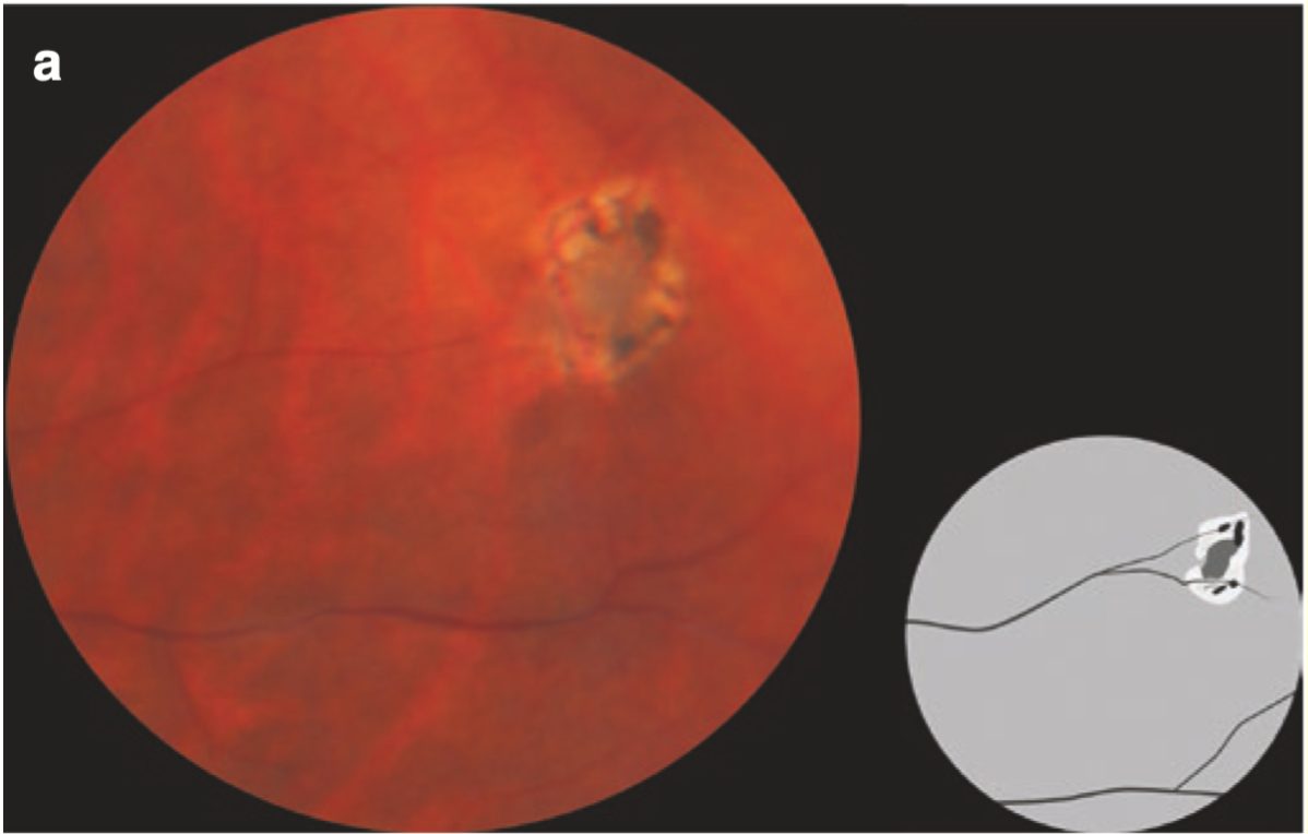 망막술(retinal tufts) 망막 주변부 변성 8