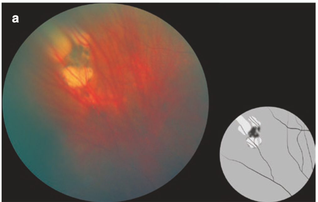 망막술(retinal tufts) - 망막 주변부 변성 8