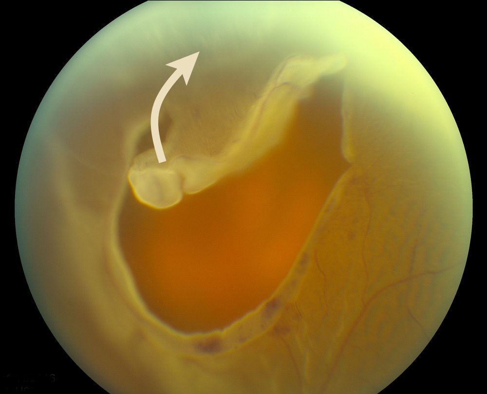 망막 열공(retinal tear) - 망막 주변부 변성 9