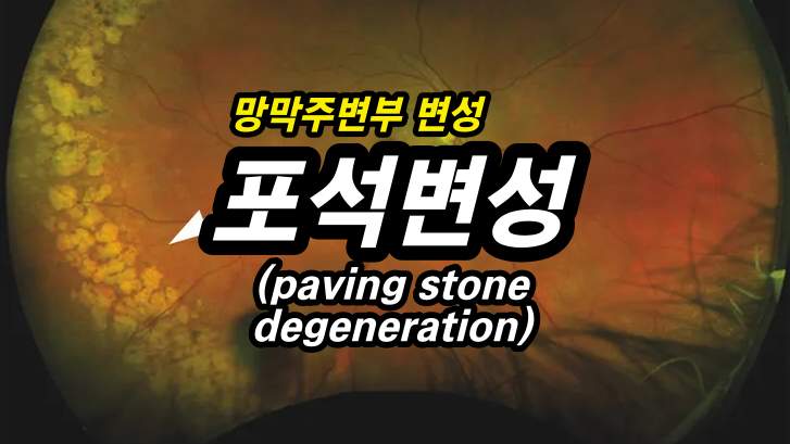 포석변성(paving-stone degeneration) - 망막 주변부 변성 10