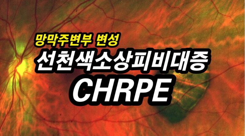 선천색소상피비대증(CHRPE) - 망막 주변부 변성 11