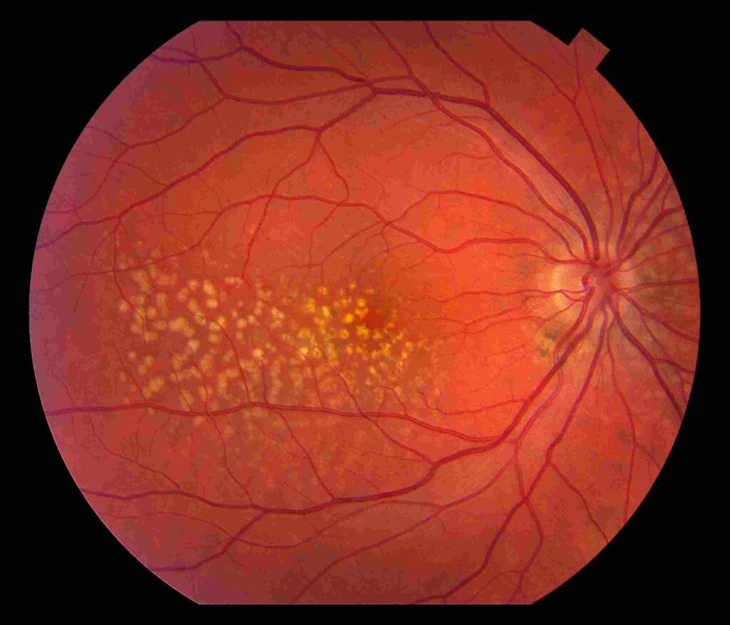 주변부 망막 드루젠(PPH retinal drusen) - 망막 주변부 변성13