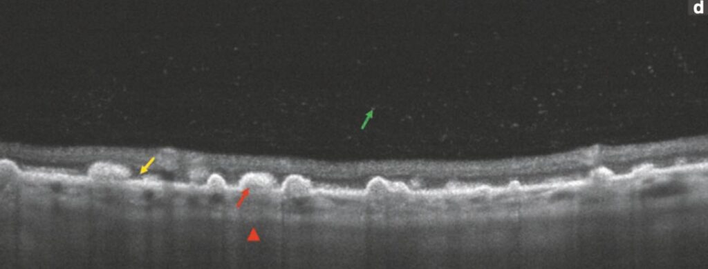 주변부 망막 드루젠(PPH retinal drusen) - 망막 주변부 변성13