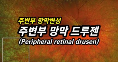 주변부 망막 드루젠(PPH retinal drusen) – 망막 주변부 변성13