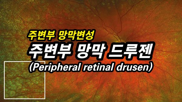 주변부 망막 드루젠(PPH retinal drusen) - 망막 주변부 변성13