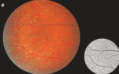 주변부 망막 드루젠(PPH retinal drusen) - 망막 주변부 변성13