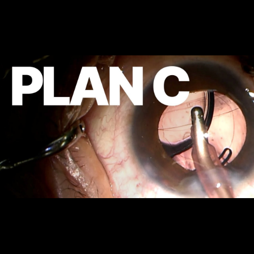 후낭파열 대처 – Reverse Optic Capture