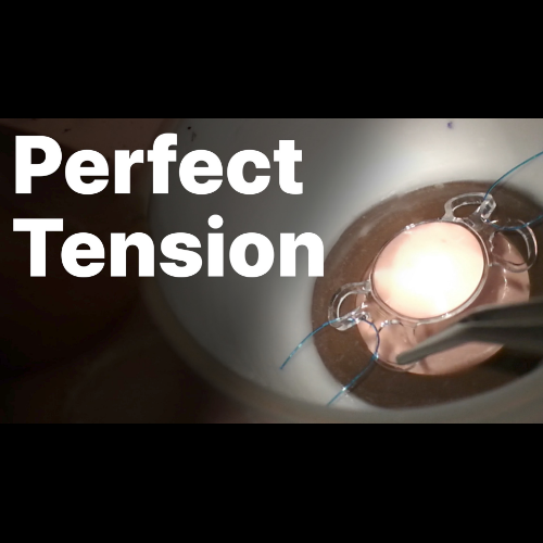 카나브라바 공막고정술 – 장력 조절